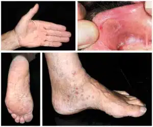 أخر مقالاتنا 23 مرض الزھري