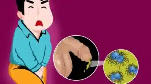 أخر مقالاتنا 20 مرض السيلان